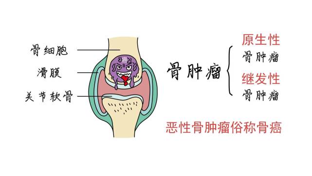 身体有肿块,半夜疼痛?要小心会不会是骨癌找上门