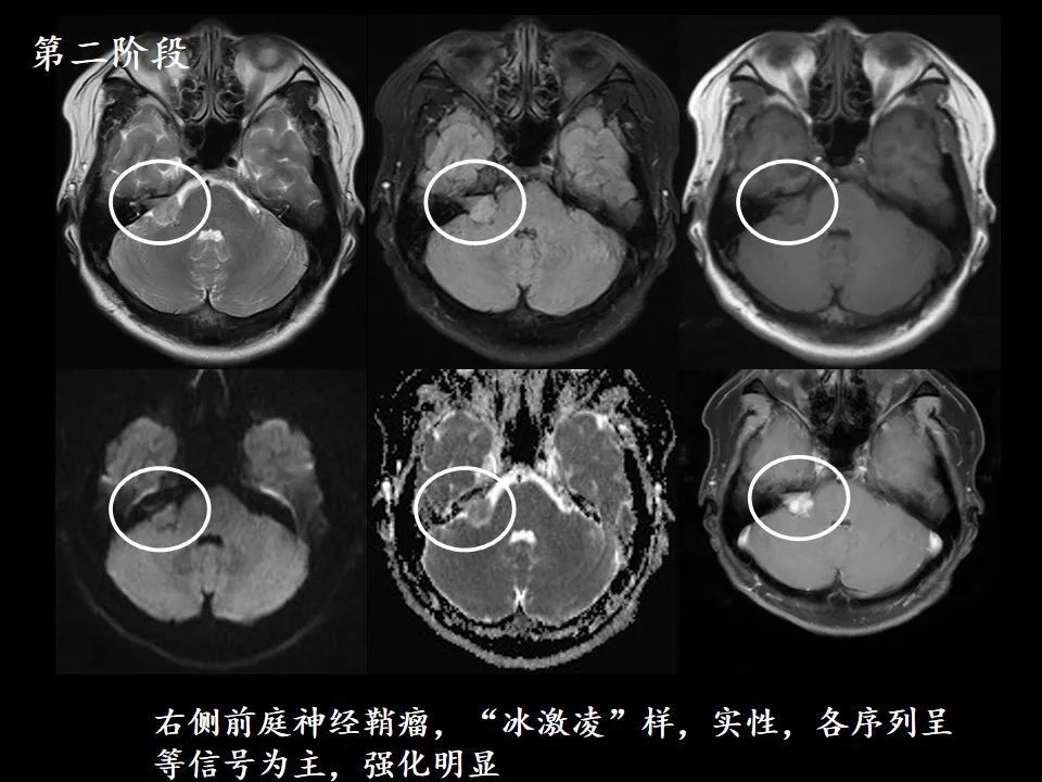 医影学堂|叫了几十年的听神经瘤,原来是错的!