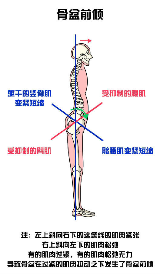 下交叉综合征而骨盆前倾也有官方学名但是一些习惯会让它不听话