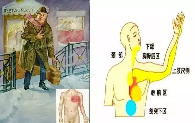 “心脏病发作”时是什么感觉？十余位女性幸存者的详细描述