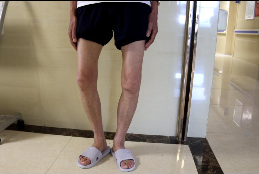 膝关节变形10年,短短两周便完成华丽蜕变?_腾讯新闻