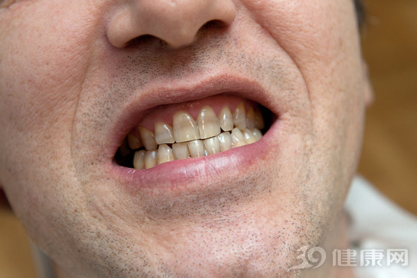 可怕…哈佛发表20年研究结果：牙不好的人，患癌风险增加52％