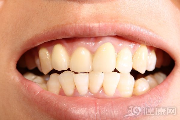 可怕…哈佛发表20年研究结果：牙不好的人，患癌风险增加52％