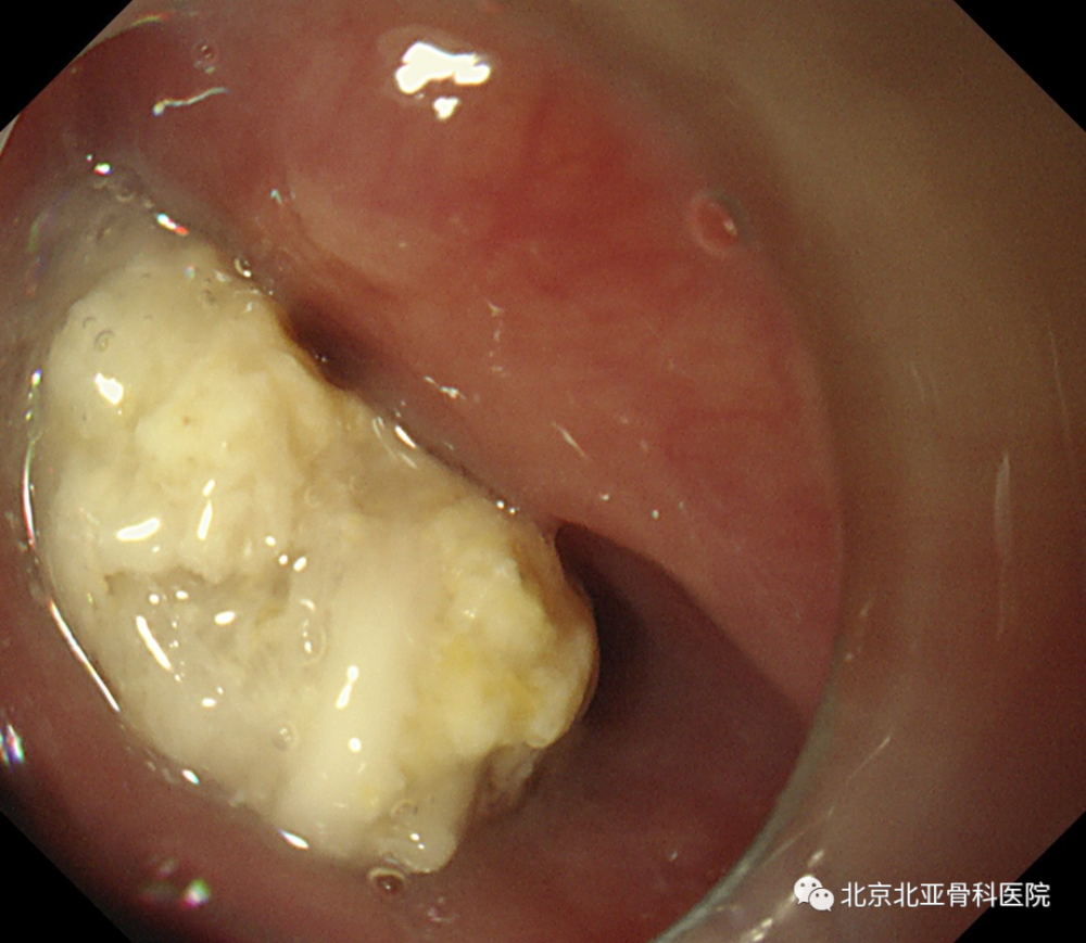 术中进镜食管距门齿17cm可见团状食物团块 异物钳 钳夹鱼刺