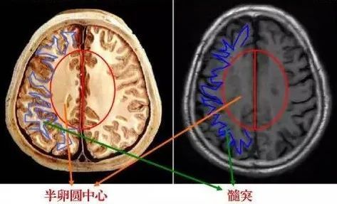 解剖|解惑:放射冠与半卵圆中心的区别_腾讯新闻