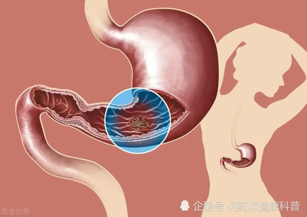 奥美拉唑、兰索拉唑、泮托拉唑、雷贝拉唑有何区别？哪种作用最好？
