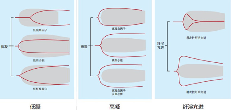 血栓弹力图，“弹”的是什么？