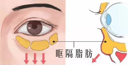 眶隔脂肪释放术缺点眶隔脂肪释放术成功率不了解的来看看