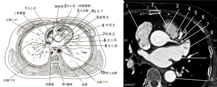心脏的这些ct切面图像,你都能识别吗?