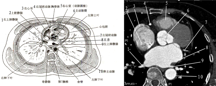心脏的这些ct切面图像,你都能识别吗?