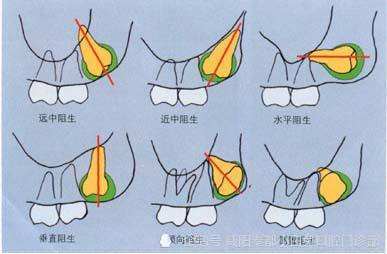 智齿拔不拔什么智齿需要拔