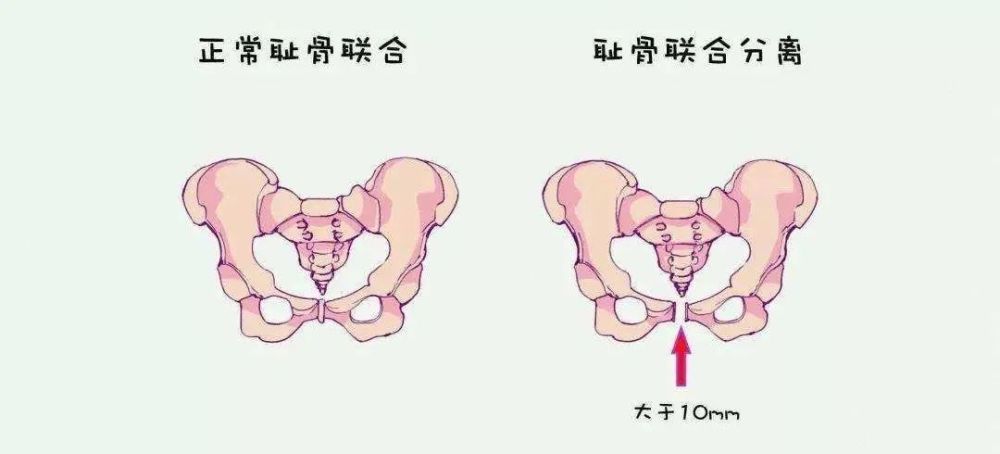 医生,我耻骨联合分离了能顺产吗?