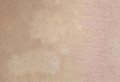 花斑藓是常见的皮肤疾病,又称为汗斑,成年人及儿童均可患病,与白癜风
