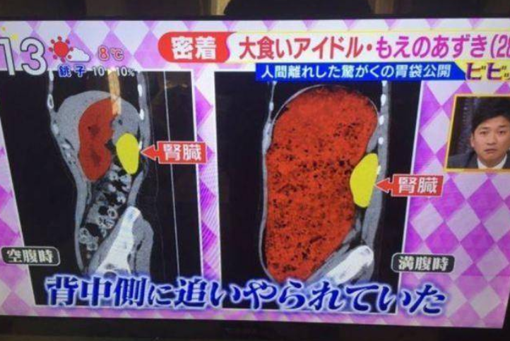大胃王暴吃不胖靠催吐？医生：此举收效甚微，还有风险