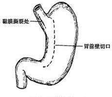 大胃王暴吃不胖靠催吐？医生：此举收效甚微，还有风险