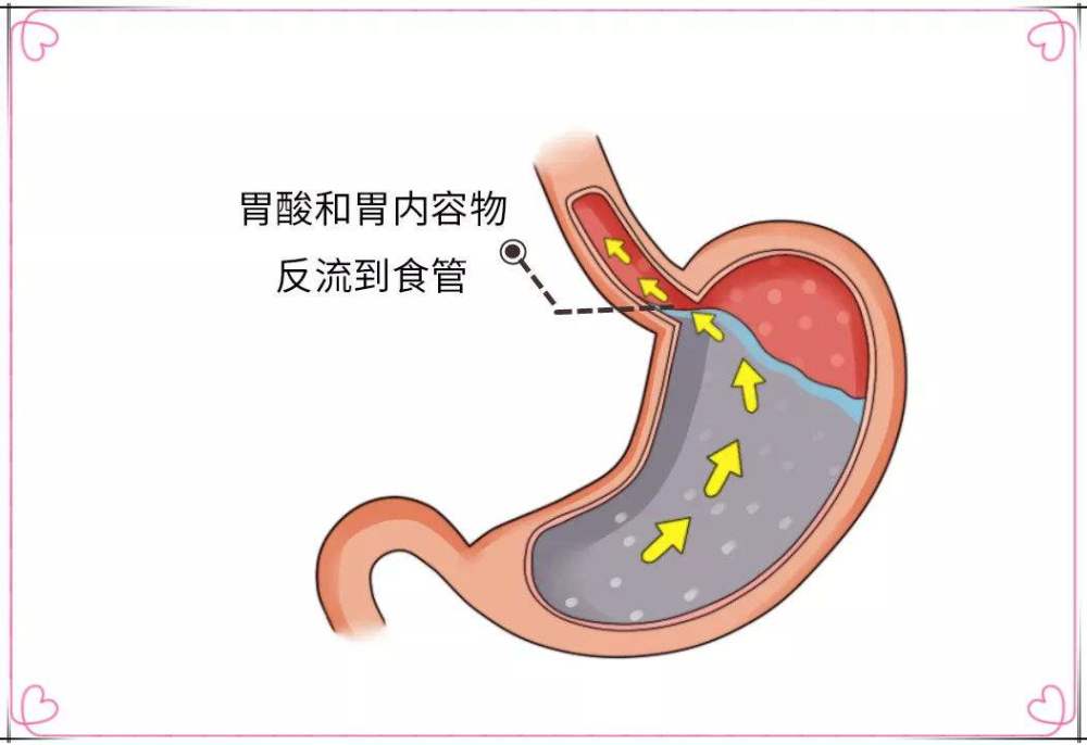 改变睡姿,解反流之苦:了解一下胃食管反流病