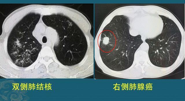 得过肺结核的人得肺癌的风险高吗怎样预防