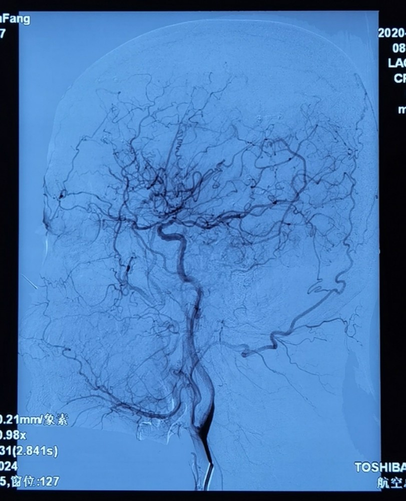 二,磁共振(mri)和磁共振血管成像(mra)