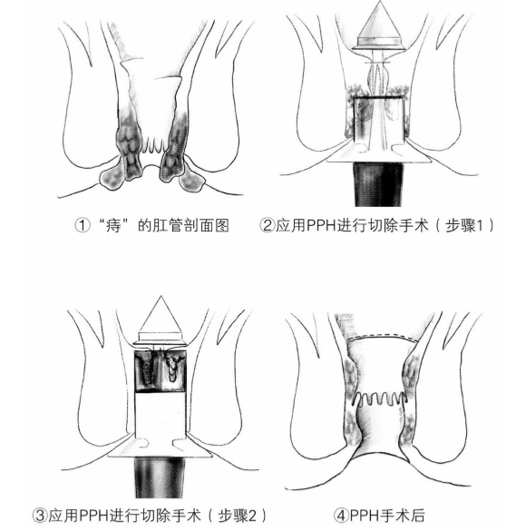 pph手术——痔疮治疗的新方法!