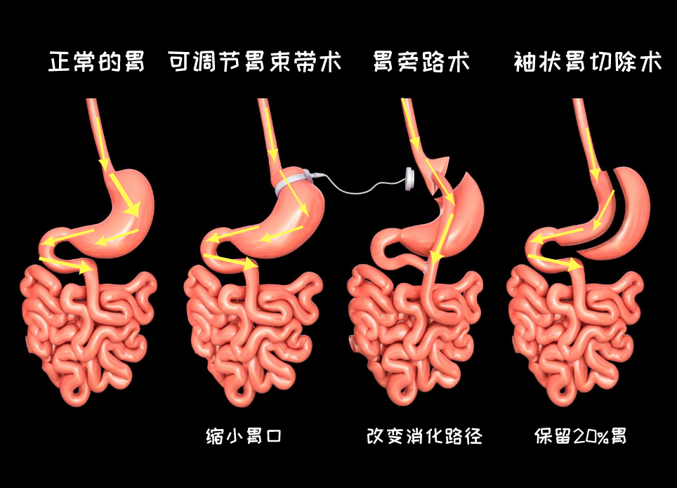 减重速度:胃旁路术 袖状胃切除手术 可调节胃束带术并发症:胃旁路