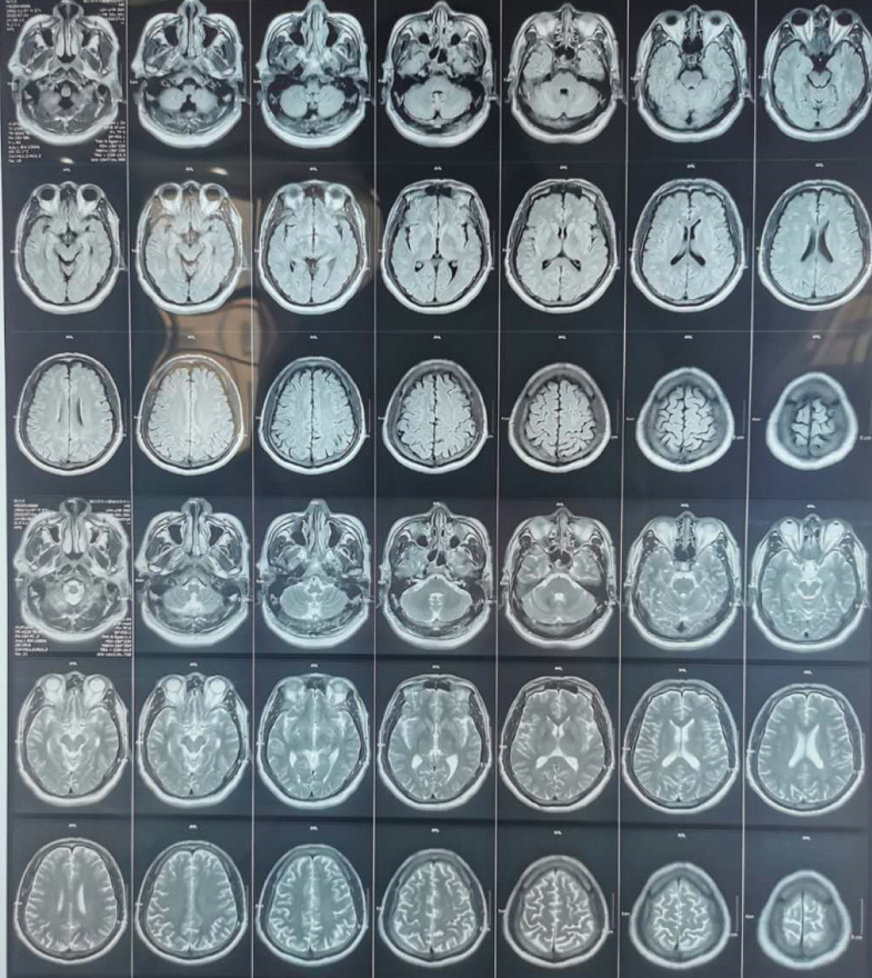 总结脑供血不足的症状与原因有哪些