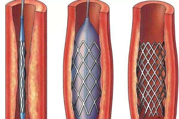 心脏做了支架最怕什么关于心脏支架的常见疑问都在这里