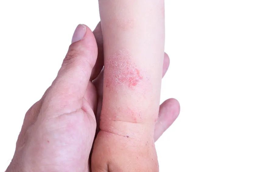 改善儿童湿疹,喷点益生菌就够了?niaid创新疗法试验结果发表