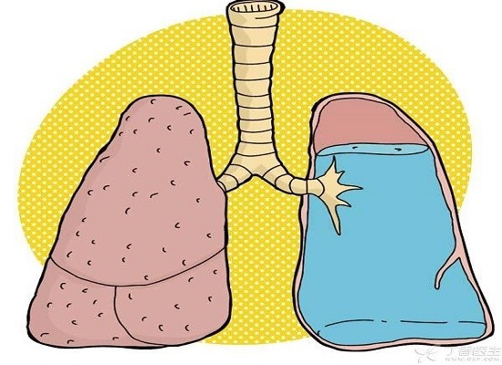 什么是肺水肿?