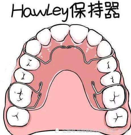 hawley 保持器