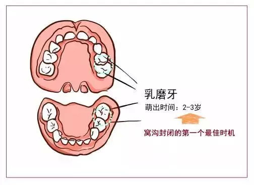 首先是2~3岁时,对刚萌出的乳磨牙进行窝沟封闭; 《第三次全