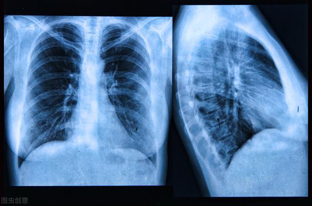 体检发现肺部结节的人越来越多,胸部ct和胸部x线有