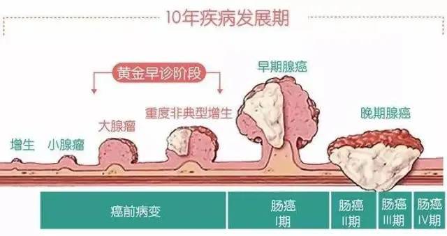 39岁白领，便血一年当痔疮，拖成晚期结肠癌