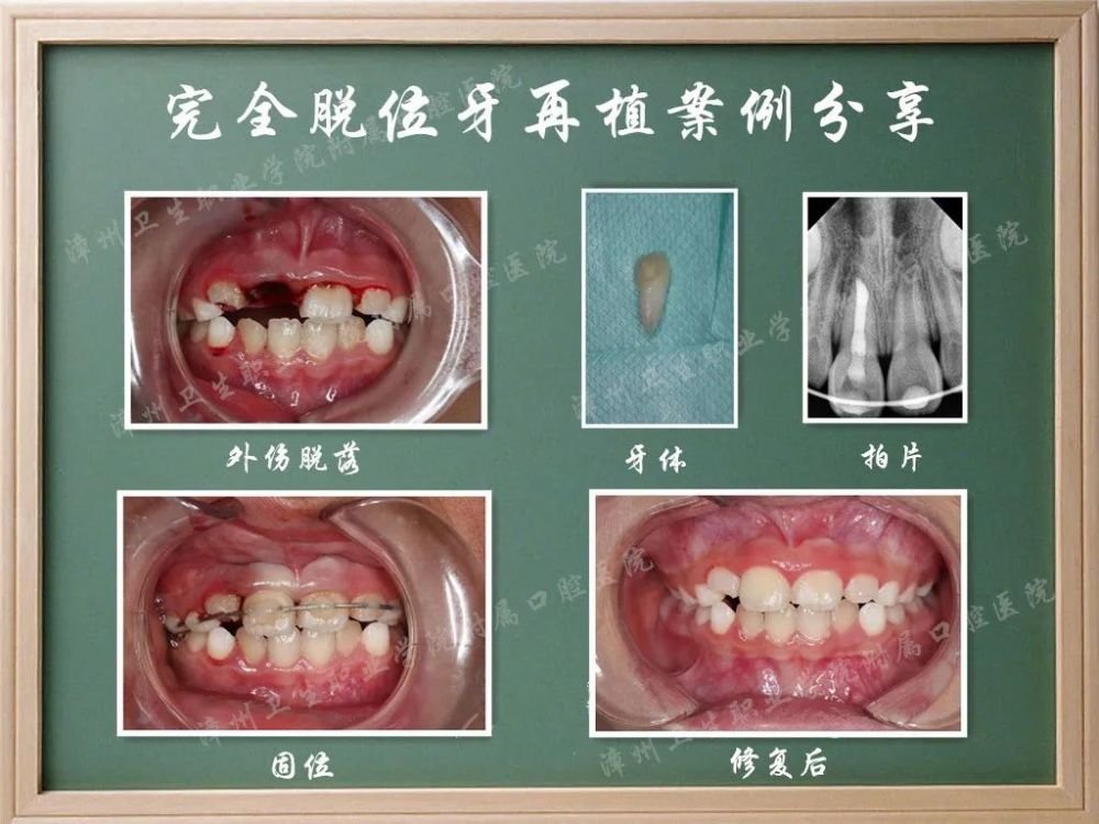 【科普】牙齿外伤的预防和应急措施