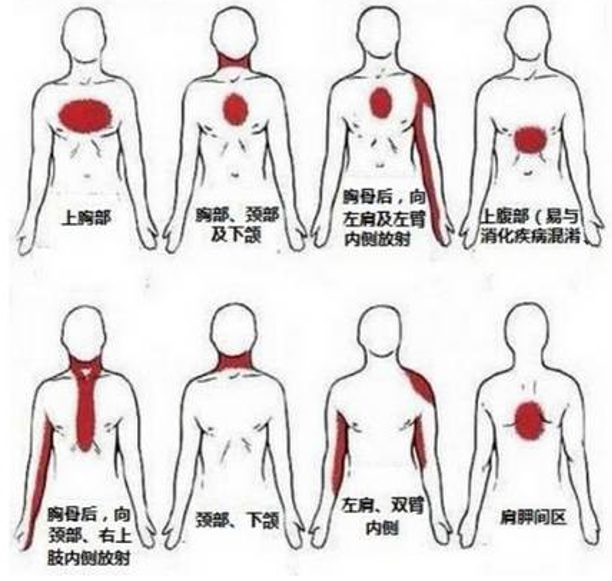 关于心梗,至少应知道这7点!