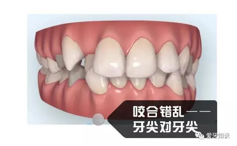 半口矫正不仅不会省钱还会导致你咬合错位