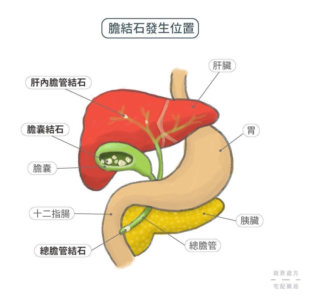 膀胱结石的症状都有些什么呢?一般典型症状多见于儿童