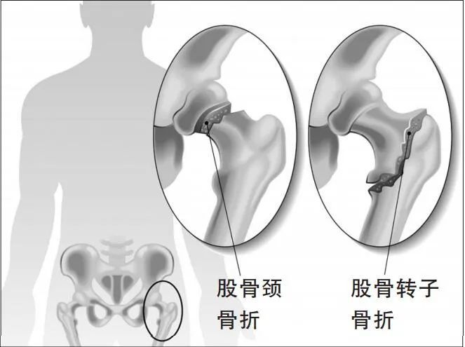 全球30％髋部骨折发生在中国！2个动作自测耗损程度