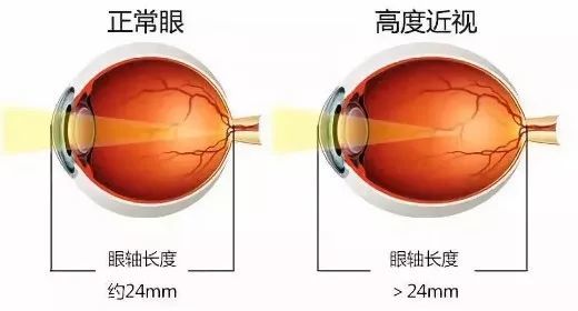 为什么孩子需要定期测眼轴