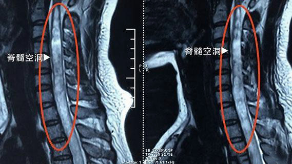 德胜门殷世荣主任:脊髓空洞症通常出现哪些症状你知道吗?