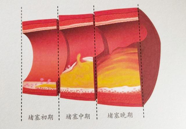 为何血管堵塞总是"静悄悄的"?等发现症状,大多堵塞已超过50%