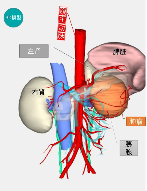 达芬奇"切除"巨大嗜铬细胞瘤 省立医院复杂肾上腺病手术添利器