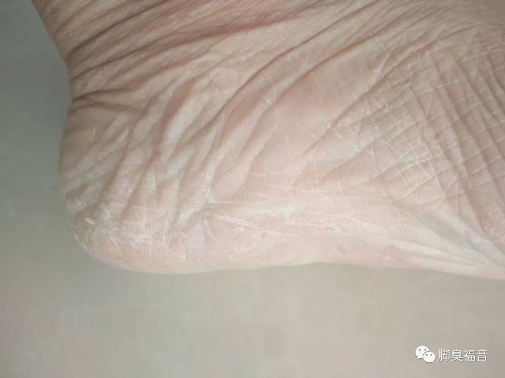 脚气水泡型怎么治（脚气水泡型怎么治能不能把水泡弄破）