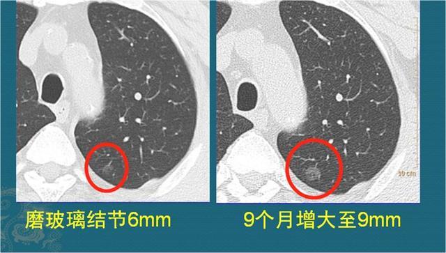 肺腺癌是怎么长出来的？哪种长得快、转移早？