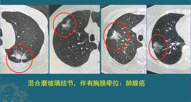 肺腺癌是怎么长出来的？哪种长得快、转移早？