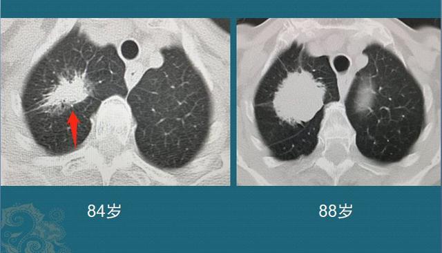 肺腺癌是怎么长出来的？哪种长得快、转移早？