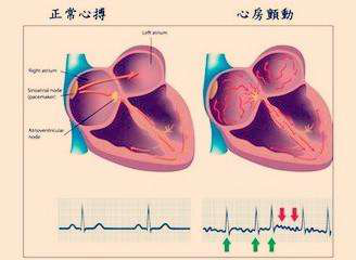 抗凝治疗心房颤动到底有没有效?