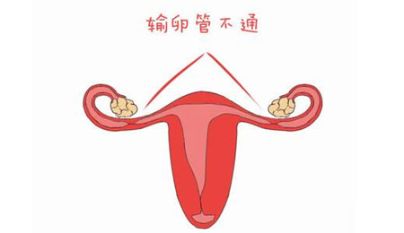 不孕是输卵管有问题吗?