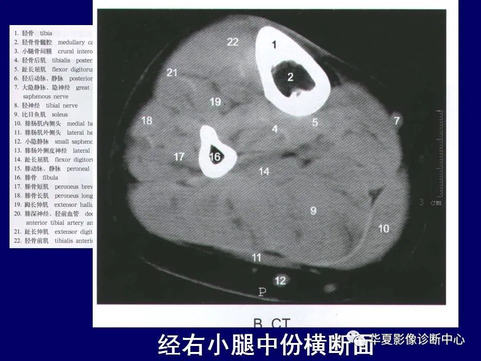 最全的下肢mri解剖