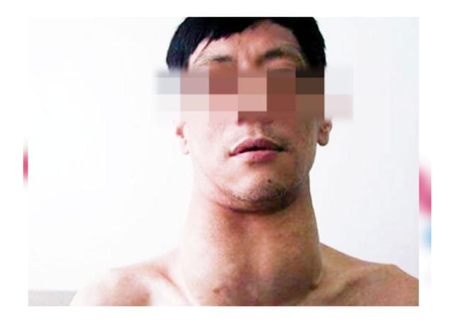 食盐与大脖子疾病有什么关系究竟是吃多了还是吃少了