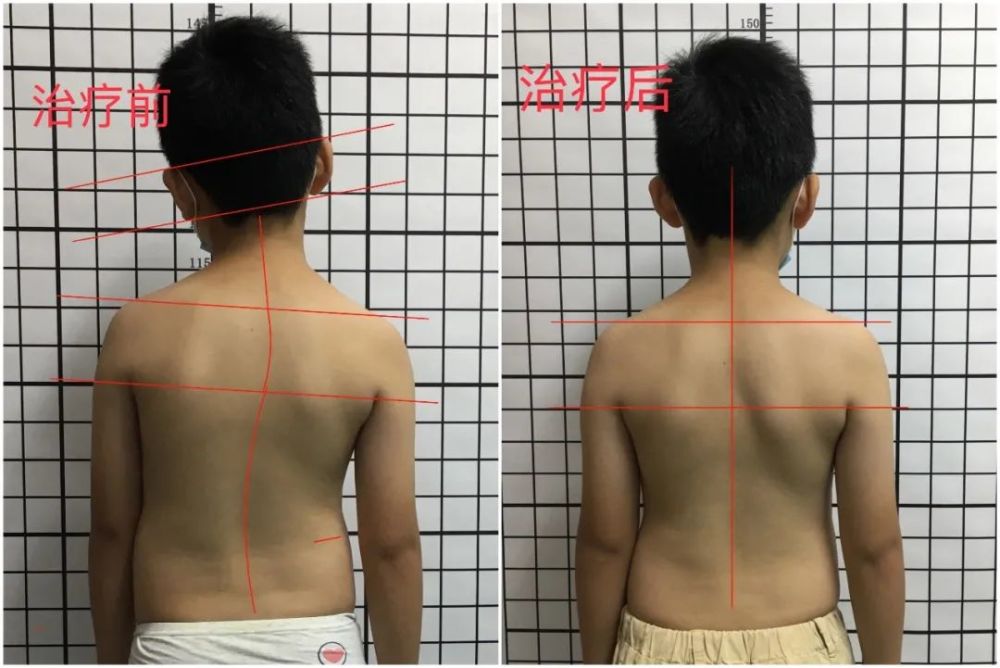 双侧肩胛下角位置不对称;3.一侧肩胛骨隆起,又称"剃刀背;4.